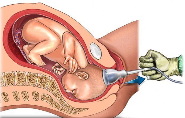 các phương pháp phá thai an toàn